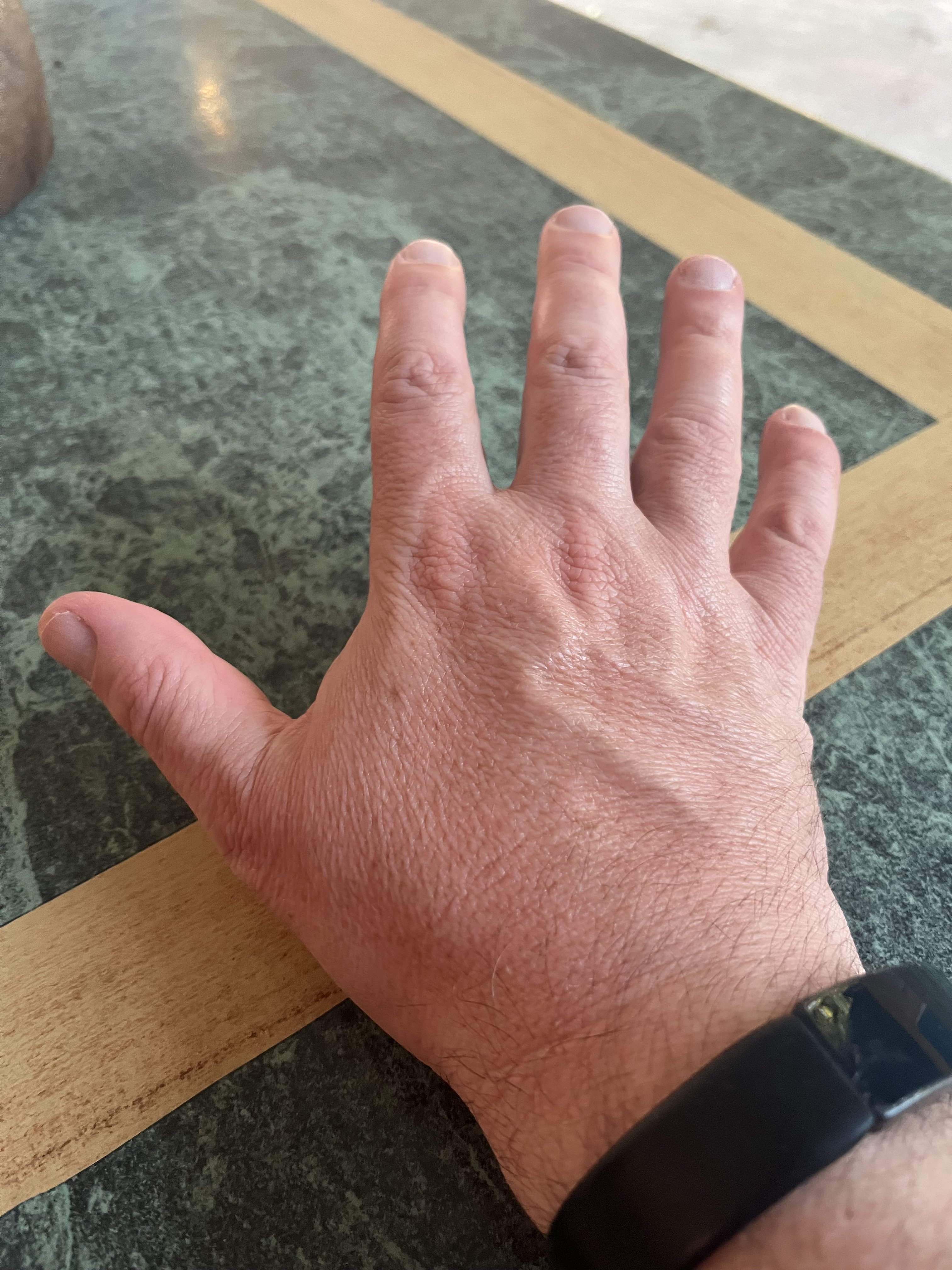17 - thankfully not my drinking arm